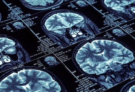 Medical scans of brain.